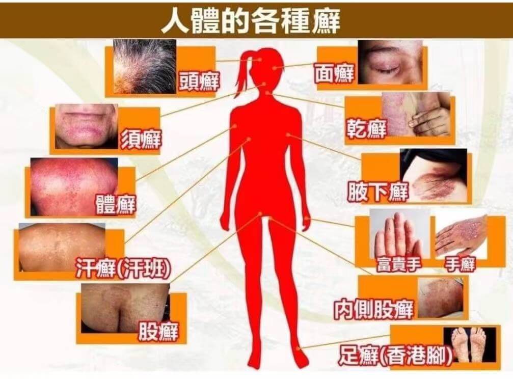 李時珍故鄉拔蘚根秘方蘚無憂百草膏